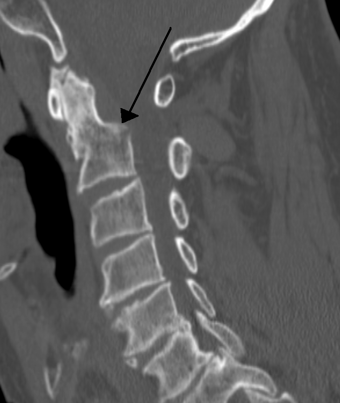 Sagittal reformatted CT of the cervical spine with an arrow indicating a fracture through the base of the odontoid peg.