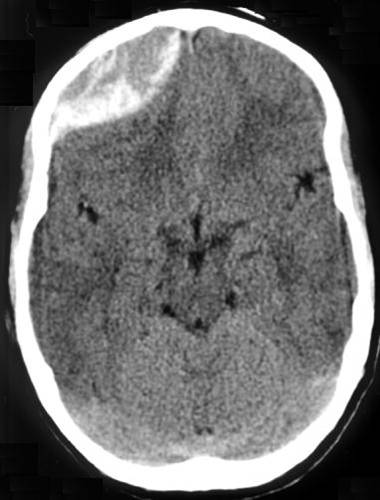 Axial non-contrast CT of the head showing a large biconvex high-density collection over the right frontal region, compressing the underlying brain.