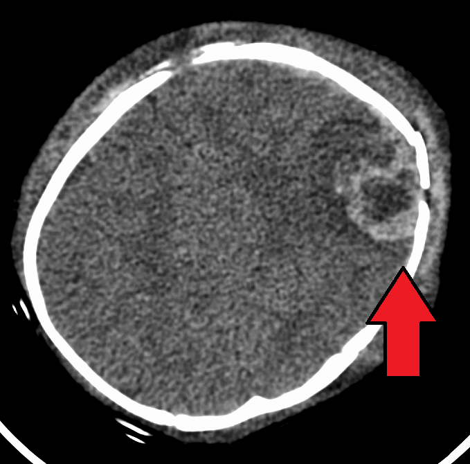 Axial non-contrast head CT of an infant; a red arrow marks a focal intraparenchymal haemorrhage with an overlying skull defect in the right parieto-temporal region.