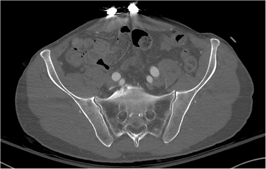 Axial CT of the pelvis with a pelvic binder in place, showing normal-appearing sacroiliac joints.