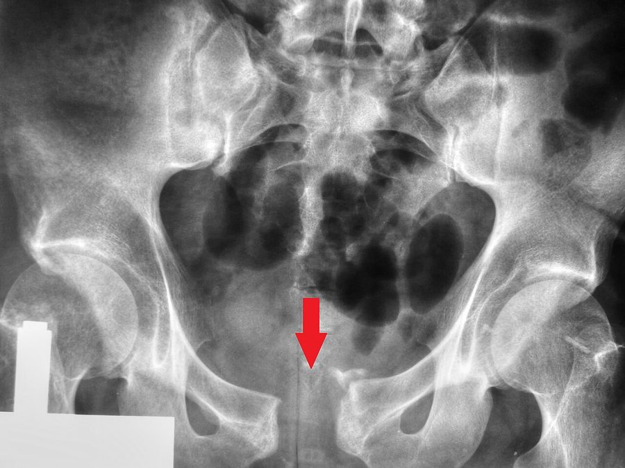 Anteroposterior pelvic radiograph with a red arrow pointing to a widened pubic symphysis after trauma.