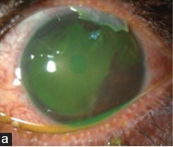 Grade I: acute ocular chemical burn with a clear cornea, iris and pupil visible, a fluorescein-staining epithelial defect and a perfused (non-blanched) limbus.