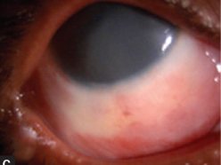 Grade II: mild corneal haze with the iris still visible and inferior perilimbal blanching affecting under a third of the limbus.