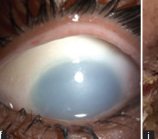 Grade IV: an opaque, porcelain-white cornea obscuring the iris and pupil with extensive perilimbal blanching over more than half of the limbus.
